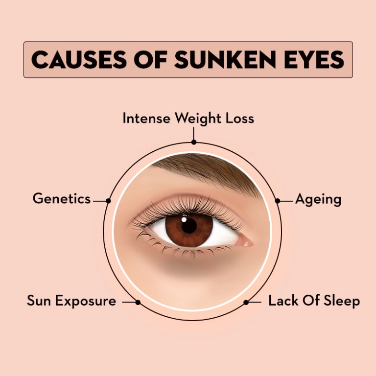 sunken eyes